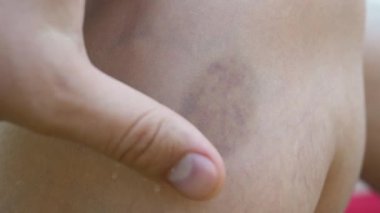 Mor büyük çürük ya da uyluk kemiğinde kanama var.