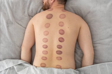 Adamın sırtındaki izler, ağrı kesici ve kas gevşemesi için kullanılan eski bir alternatif ilaç türü olan kupa terapisinden kaynaklanan geniş, koyu mor, dairesel izler (ekimozis).