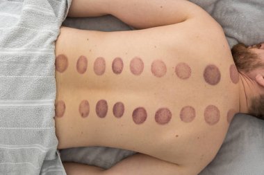 Adamın sırtındaki izler, ağrı kesici ve kas gevşemesi için kullanılan eski bir alternatif ilaç türü olan kupa terapisinden kaynaklanan geniş, koyu mor, dairesel izler (ekimozis).