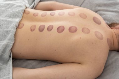 Adamın sırtındaki izler, ağrı kesici ve kas gevşemesi için kullanılan eski bir alternatif ilaç türü olan kupa terapisinden kaynaklanan geniş, koyu mor, dairesel izler (ekimozis).