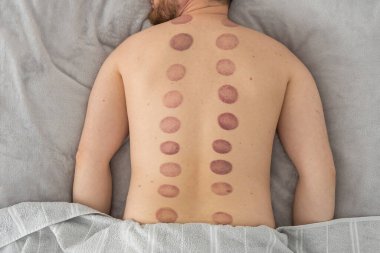 Adamın sırtındaki izler, ağrı kesici ve kas gevşemesi için kullanılan eski bir alternatif ilaç türü olan kupa terapisinden kaynaklanan geniş, koyu mor, dairesel izler (ekimozis).