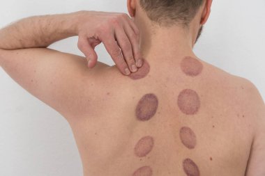 Bir adamın çıplak sırtında, geniş, mor, oval şekilli birkaç çürük, bir kupa terapisinden sonra, omurga boyunca uzanan iki dikey çizgide sıralanır.