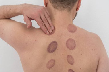 Bir adamın çıplak sırtında, geniş, mor, oval şekilli birkaç çürük, bir kupa terapisinden sonra, omurga boyunca uzanan iki dikey çizgide sıralanır.