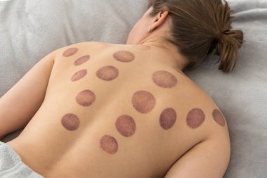 Bir kadının çıplak sırtında çok sayıda geniş, dairesel, derin mor morluklar görülüyor. Bu tipik bir kupa terapisi. İzler üst, orta, arka ve omuzlarına yayılmış.