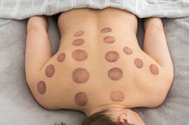 Bir kadının çıplak sırtında çok sayıda geniş, dairesel, derin mor morluklar görülüyor. Bu tipik bir kupa terapisi. İzler üst, orta, arka ve omuzlarına yayılmış.