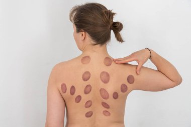 Bir kadının çıplak sırtında çok sayıda geniş, dairesel, derin mor morluklar görülüyor. Bu tipik bir kupa terapisi. İzler üst, orta, arka ve omuzlarına yayılmış.