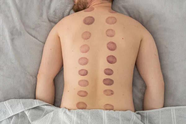 Adamın sırtındaki izler, ağrı kesici ve kas gevşemesi için kullanılan eski bir alternatif ilaç türü olan kupa terapisinden kaynaklanan geniş, koyu mor, dairesel izler (ekimozis).