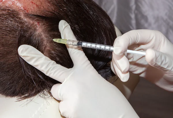 Haarwachstum stimulierende Injektion — Stockfoto