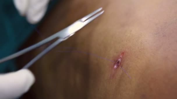 Шов от хирурга — стоковое видео