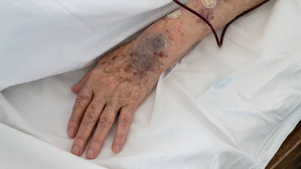 土耳其安卡拉 2021年3月 一名有瘀伤的老年人的胳膊在医院房间接受输血血清 — 图库照片