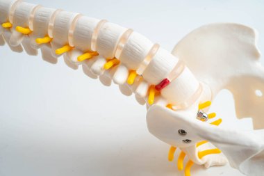 Omurga ve kemik, bel kemiği yerinden oynamış disk parçası, ortopedi bölümünde tedavi için model..