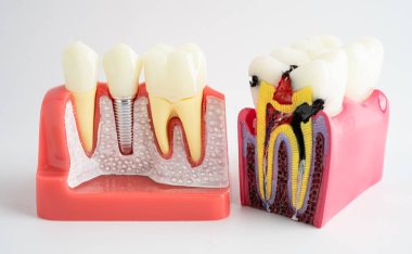 Diş implantı, çeneye yapay diş kökleri, diş tedavisinin kök kanalı, diş eti hastalığı, diş hekimliği üzerine çalışan dişçi modeli.