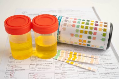 İdrar tahlili, reaksiyonlu idrar kabı. PH kağıt testi ve karşılaştırma tablosu laboratuvarda..
