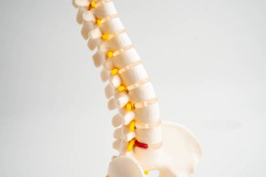 Omurga ve kemik, bel kemiği yerinden oynamış disk parçası, ortopedi bölümünde tedavi için model..