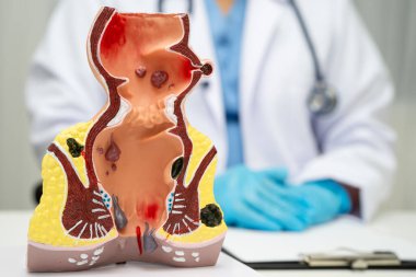 Hastanede rektum ve hemoroit insan anatomisi modeli olan Asyalı bir doktor vasküler yapısında iltihaplanma var..