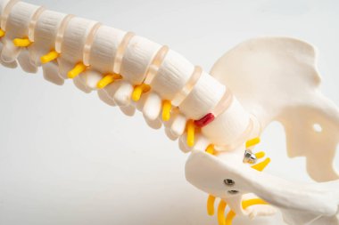 Omurga ve kemik, bel kemiği yerinden oynamış disk parçası, ortopedi bölümünde tedavi için model..