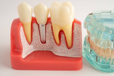 Diş implantı, çeneye yapay diş kökleri, diş tedavisinin kök kanalı, diş eti hastalığı, diş hekimliği üzerine çalışan dişçi modeli.