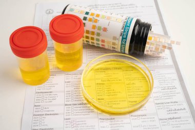 İdrar tahlili, reaksiyonlu idrar kabı. PH kağıt testi ve karşılaştırma tablosu laboratuvarda..