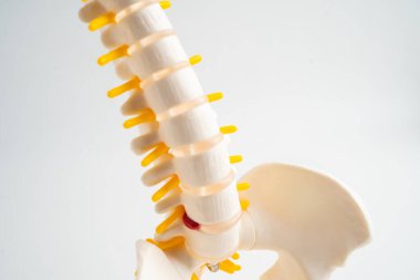 Omurga ve kemik, bel kemiği yerinden oynamış disk parçası, ortopedi bölümünde tedavi için model..