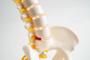 Omurga ve kemik, bel kemiği yerinden oynamış disk parçası, ortopedi bölümünde tedavi için model..