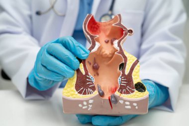 Hastanede rektum ve hemoroit insan anatomisi modeli olan Asyalı bir doktor vasküler yapısında iltihaplanma var..