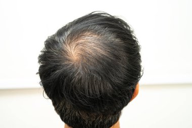 Kel kafalı adam, saç dökülmesi tedavisi sorunu.