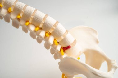 Omurga ve kemik, bel kemiği yerinden oynamış disk parçası, ortopedi bölümünde tedavi için model..