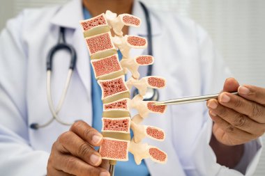 Doktor, ortopedi bölümünde tedavi için kemik modelinde osteoporoz tutuyor..