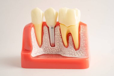 Diş implantı, çeneye yapay diş kökleri, diş tedavisinin kök kanalı, diş eti hastalığı, diş hekimliği üzerine çalışan dişçi modeli.