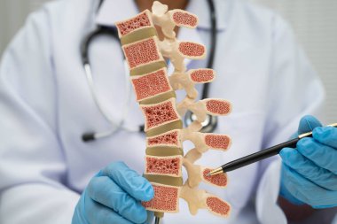 Tıbbi tedavi için kemik modelinde osteoporoz tutan doktor..