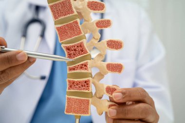 Doktor, ortopedi bölümünde tedavi için kemik modelinde osteoporoz tutuyor..