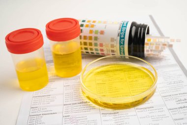 İdrar tahlili, reaksiyonlu idrar kabı. PH kağıt testi ve karşılaştırma tablosu laboratuvarda..