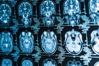 kafa ve beynin bir dizi MRI görüntüsü, manyetik rezonans görüntüleme konsepti