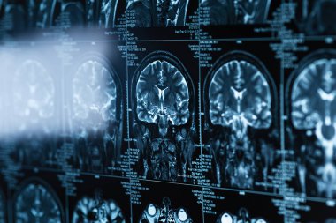 kafa ve beynin bir dizi MRI görüntüleri, manyetik rezonans görüntüleme konsepti, dünya kanseri günü