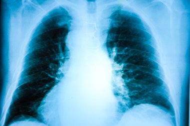 bir insanın göğüs resimden Xray