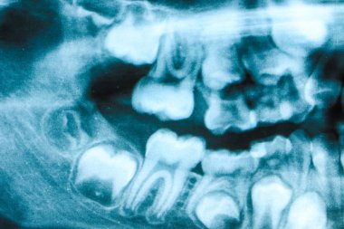 Xray dişlerin doğru görme 