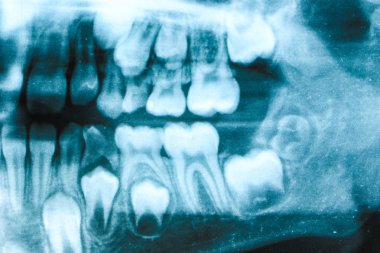 Xray diş sol görme 