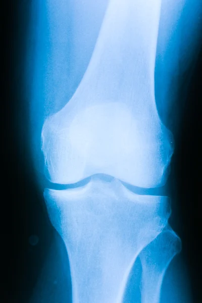 xray picture of a knee