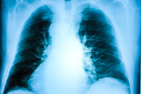 Рентгенівське зображення з грудей людини — стокове фото