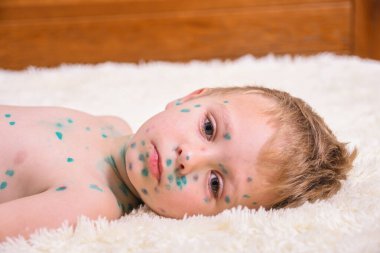 Genç çocuk, suçiçeği olan çocuk. Suçiçeği hastası bir çocuk. Çocuk vücudunda ve yüzünde Varicella virüsü veya suçiçeği kabarcığı kızarıklığı