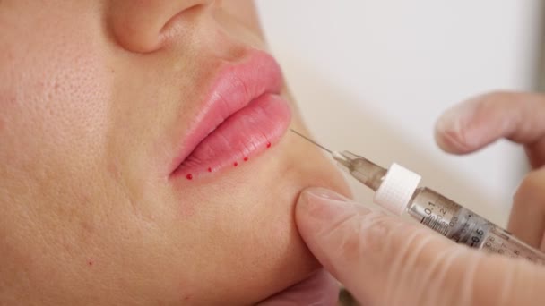 Close-up of a doctor making an injection into a womans lower lip — Stok Video