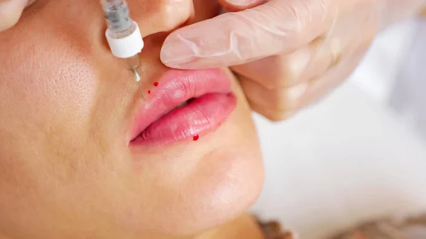 Beautician performs lips augmentation operation closeup — Stock Photo, Image