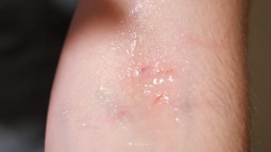 Bir çiziğin hidrojen peroksit tedavisine yakın çekim