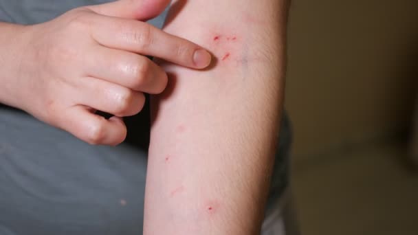 Mujer señala arañazos y mordeduras en su brazo — Vídeo de stock