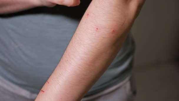 Γυναικείο χέρι γδαρμένο από γάτα — Αρχείο Βίντεο