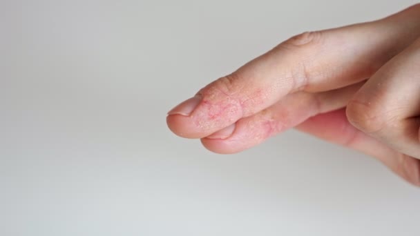 Пальцы человека с псориазом и экземой — стоковое видео