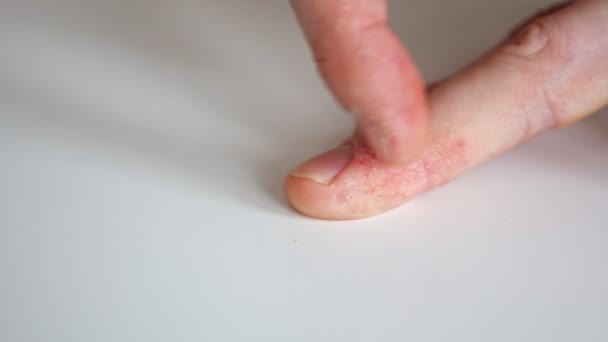 El hombre se rasca los dedos con psoriasis. — Vídeos de Stock