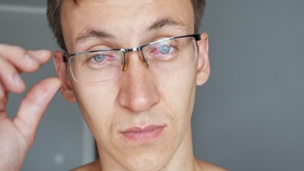 Mann nimmt Brille von geröteten Augen ab — Stockvideo