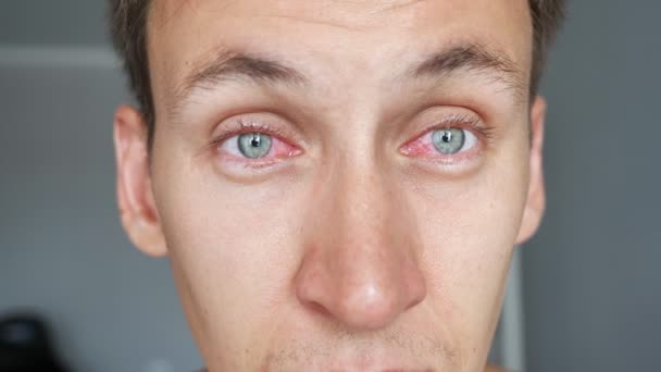 Jovem com olhos vermelhos — Vídeo de Stock