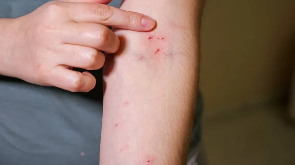 Mujer señala arañazos y mordeduras en su brazo —  Fotos de Stock